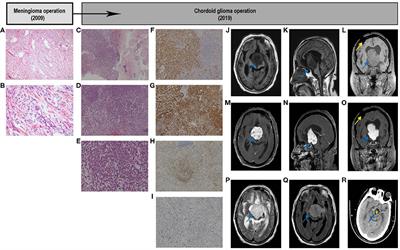 Occurrence of Chordoid Glioma With Sodium Ion Metabolism Disorder 5 Years After Meningioma Surgery and Whole-Exome Sequencing: A Case Report and Literature Review